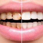 teeth-before-and-after-960w